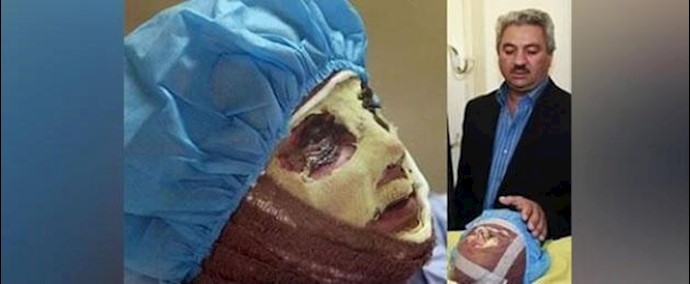 إيران- والد «سهيلا» التي أصبحت ضحية لعملية رش الأسيد علی وجهها في مدينة إصفهان: علی الرغم من إجراء 20 علمية جراحية علی ابنتي، مازالوا لم يعطوا اللباس الخاص لها