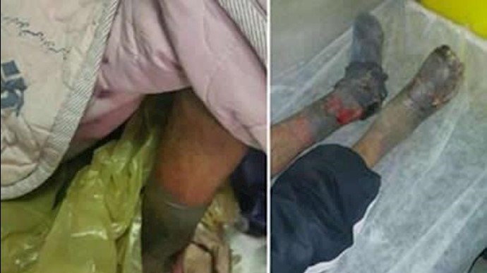 مواطن ينام في الکراتين يتم قطع کلتا رجليه نتيجة الصقيع في مدينة همدان