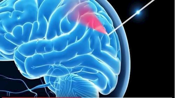 إبرة ذکية تجعل جراحات المخ أکثر أمانا
