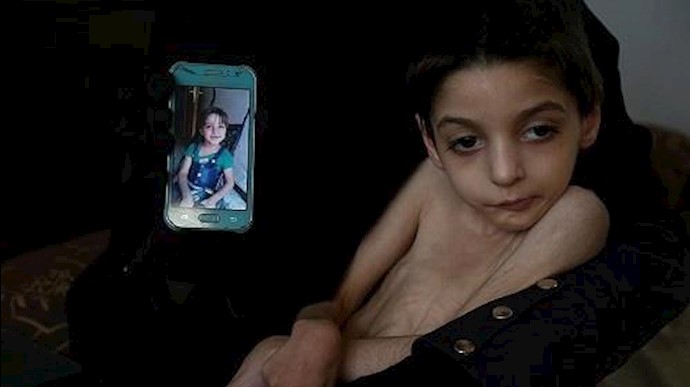 الطفلة "رهف" من غوطة دمشق.. لحظات تفصلها عن الموت